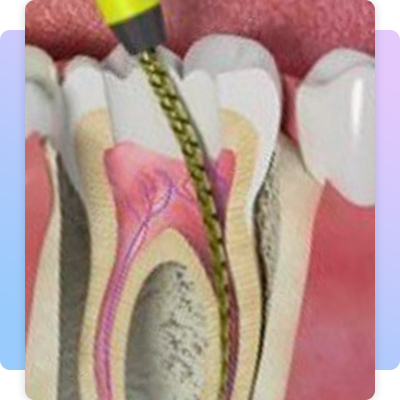 Root canal treatment